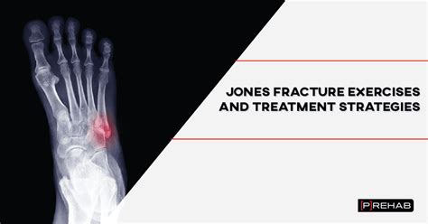 Jones Fracture Exercises and Treatment Strategies | [P]rehab