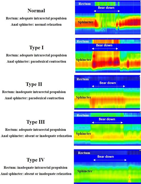 Types Of Pelvic Floor Dyssynergia | Viewfloor.co