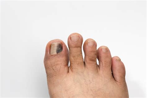 Are Black Toenails Really A Big Deal For A Runner?