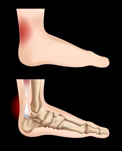 Diagram showing tendon injury 292998 Vector Art at Vecteezy