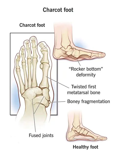 Charcot foot - Ankle & Foot Clinic-Diabetes Foot clinic India