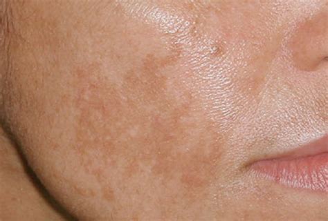 Melasma - Treatment, Pictures, Symptoms, Causes - (2018 - Updated)