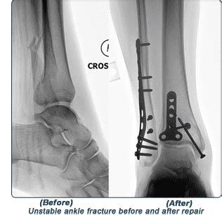 Bimalleolar ankle fracture surgery - enstat