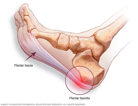 Plantar fasciitis - Symptoms and causes - Mayo Clinic