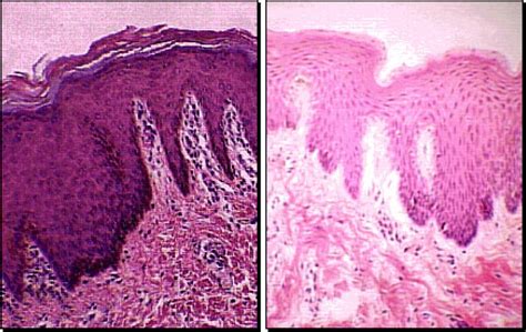 stratified squamous epithelium keratinized