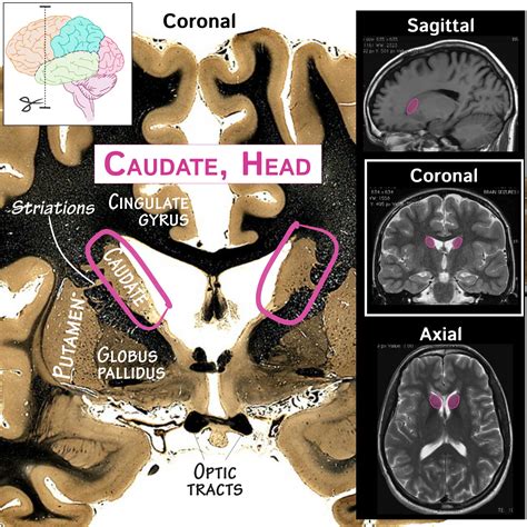 Neuroanatomy Glossary: Caudate nucleus, head | Draw It to Know It