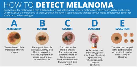 The Weather Network - How to detect melanoma using the ABCDE method