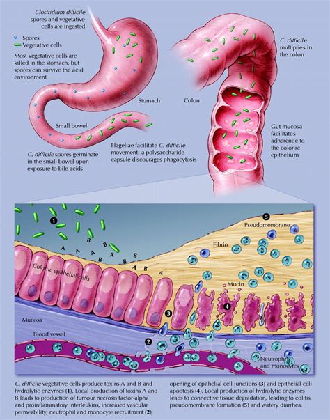 Fecal transplants successful for treating C. di...