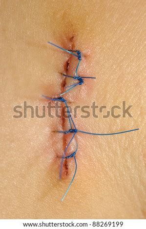 Wound With Surgical Stitch Stock Photo 88269199 : Shutterstock