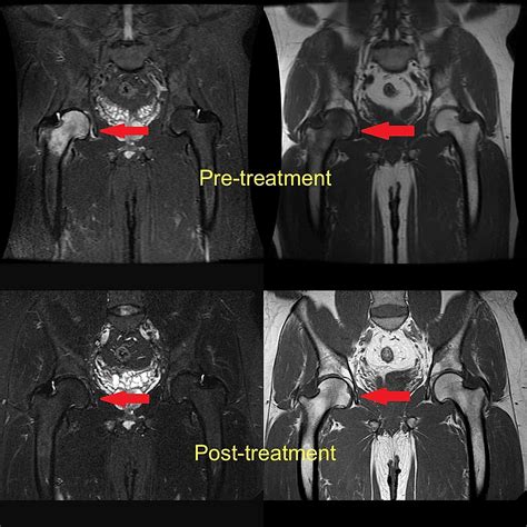 Cureus | Effectiveness of Iloprost in the Treatment of Bone Marrow Edema