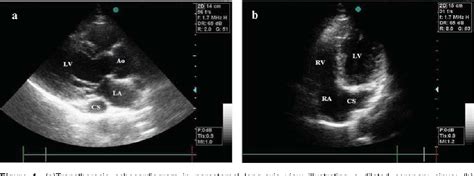 Figure 3 from Persistent Left Superior Vena Cava Draining into the ...