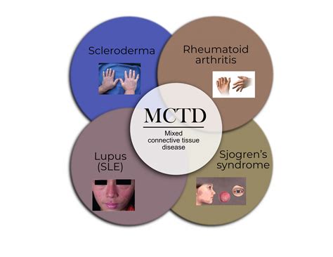 What Is Connective Tissue Disease and Does Massage Help? - Massage ...