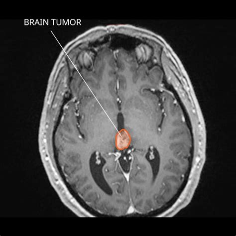 Brain Tumor Mri Without Contrast