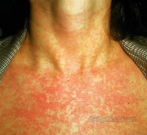 Fungal Rash – Pictures, Treatment, Symptoms, Causes