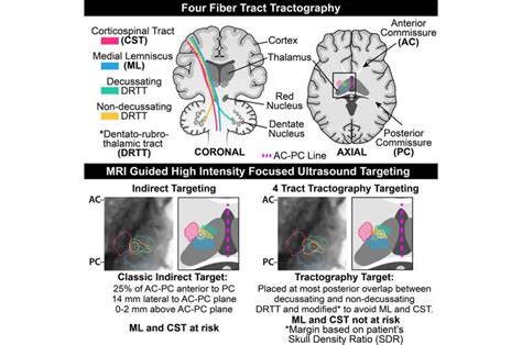 New technique improves high-intensity focused ultrasound treatment for ...