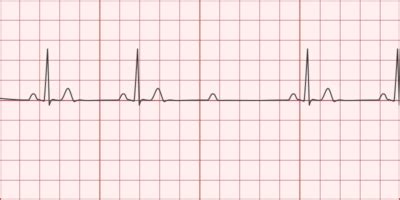 2nd Degree AV Block (Mobitz Type II) - Differential Diagnosis of