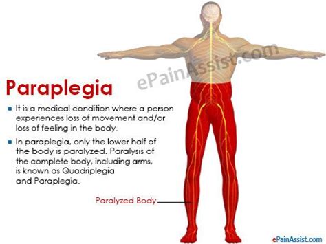 Paraplegia | Paraplegia, Quadriplegia, Treatment