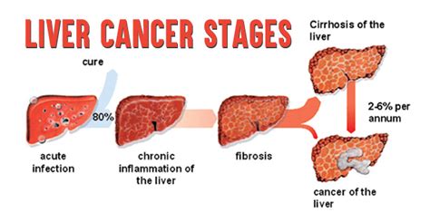 Liver Cancer Stages- How Stages of Lung Cancer are Determined!