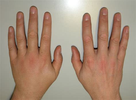 Sprained finger facts | General center | SteadyHealth.com