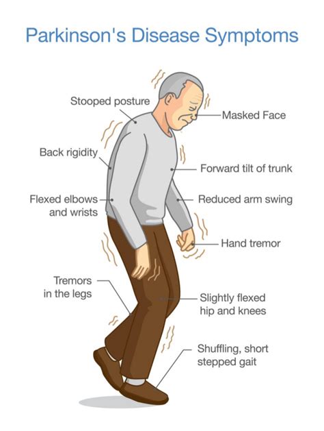 Parkinson's Disease Exam | Stanford Medicine 25 | Stanford Medicine