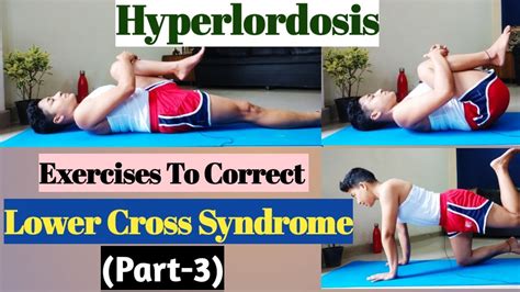 Hyperlordosis | Exercises To Correct Lower Cross Syndrome | (Part-3 ...