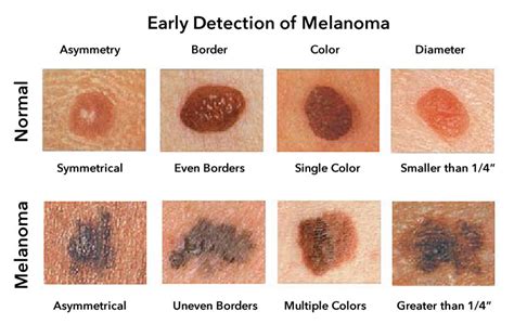 Melanoma Skin Cancer, Types, Stages, Signs, Symptoms & Treatment ...