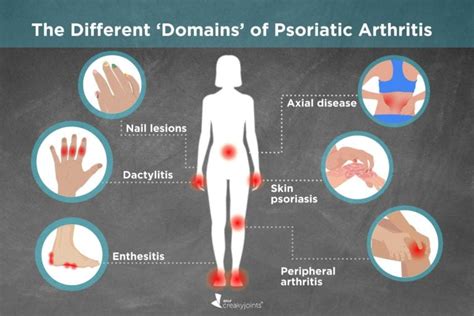 Different Types of Psoriatic Arthritis: Symptoms, Treatments, Outcomes