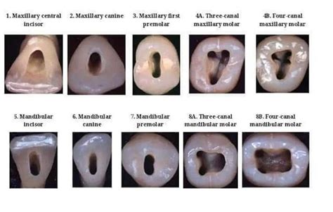 Access Cavity Preparation. | Dental help, Dentistry, Dental facts