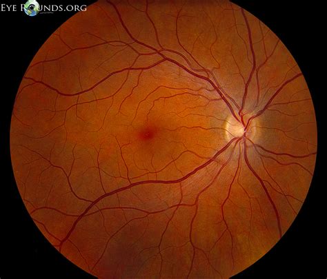 Atlas Entry - Normal fundus - adult