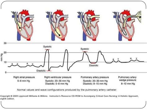 pulmonary artery catheter waveforms - Google Search | Med | Pinterest ...