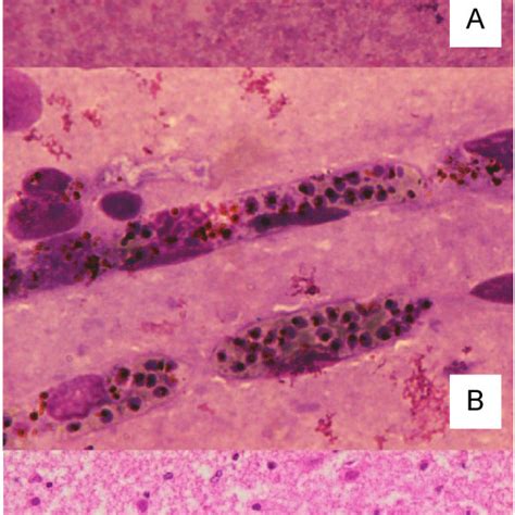 Light microscopy of brain tissue obtained from children dying from ...