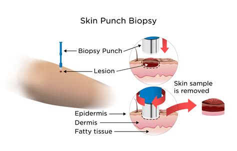 Skin Biopsy | My Doctor Online