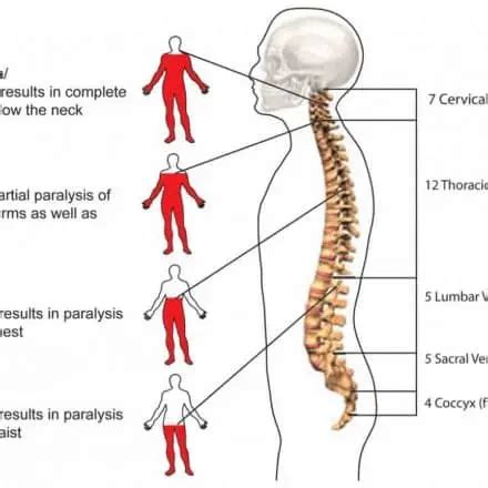 spinal cord injury ppt Archives - Samarpan Physiotherapy Clinic