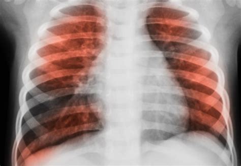 Glucose in the airways could increase infections in lung disease ...