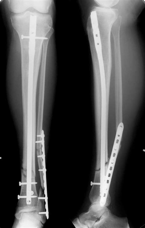 Tibia And Fibula Fracture Surgery