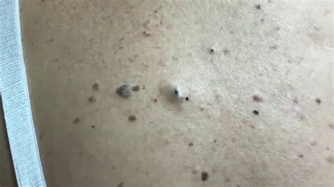 Dr. Pimple Popper -- Deepest Blackhead You Have Ever Seen!