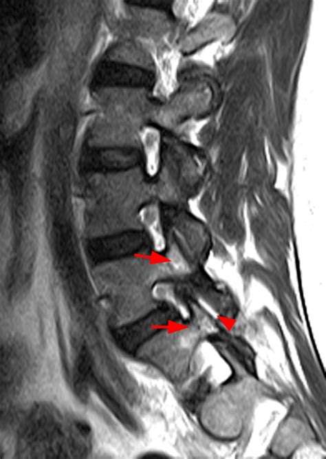 Facet Synovitis | Radsource