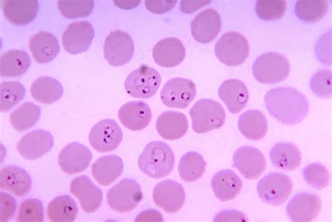 Free picture: photomicrograph, blood smear, plasmodium falciparum ...