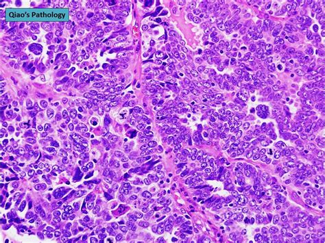 Serous Ovarian Cancer Histology - CancerWalls