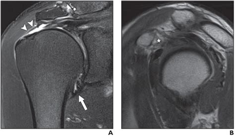 MRI findings predict shoulder stiffness for rotator cuff tears ...