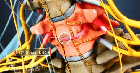 Lumbar Nerve Root Radiculopathy Symptoms