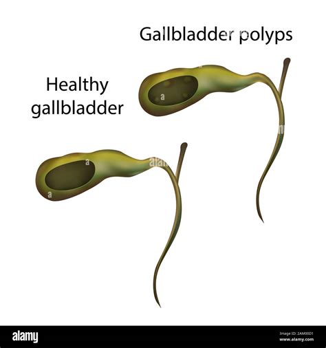 Gallbladder polyps hi-res stock photography and images - Alamy