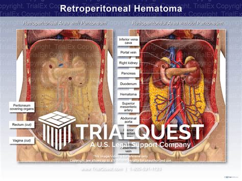 Retroperitoneal Hematoma - TrialExhibits Inc.