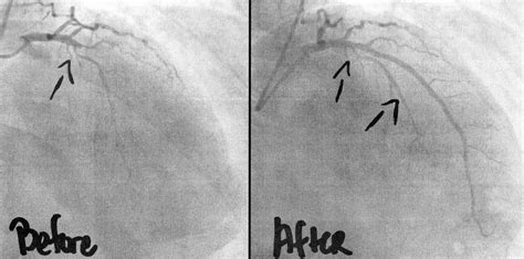 Coronary Angiography