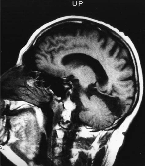 MRI scan demonstrating lesions of the inferior gyrus, lateral occipital ...