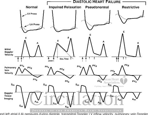 [PDF] New concepts in diastolic dysfunction and diastolic heart failure ...