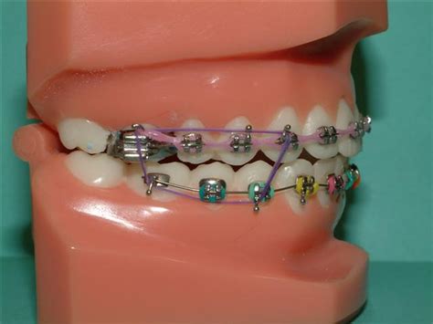 Elastics - Braces By Henry : Braces By Henry