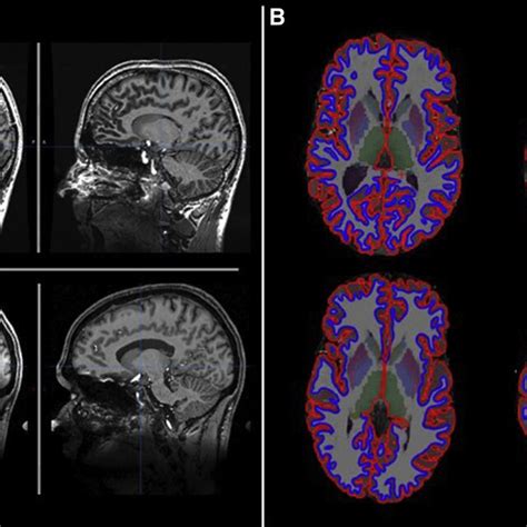 Axial cuts through the corpus striatum illustrating visually tractable ...