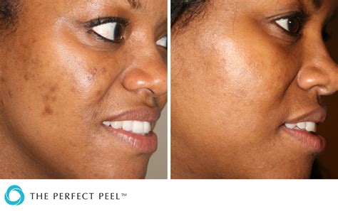 Chemical Peels - Perfect Peel® | Renew Medical Aesthetics - Cheshire