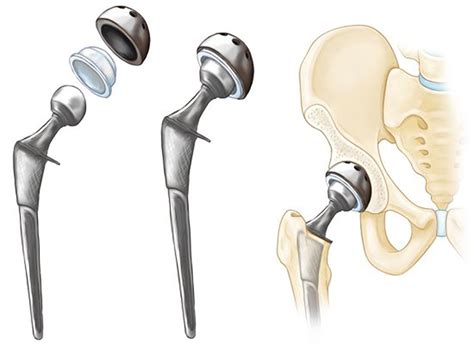 Less Invasive Hip Joint Replacement - Stephen J. Incavo, MD